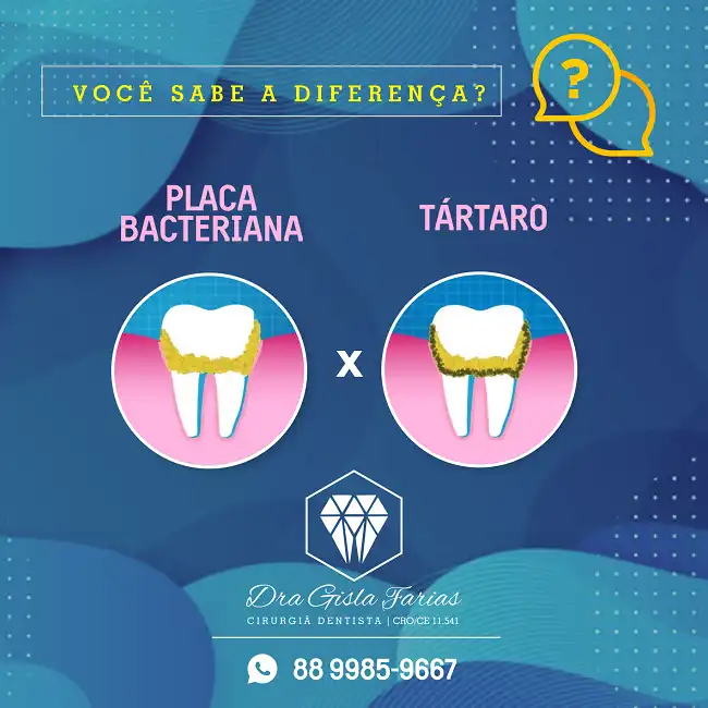 Propaganda Diferença Placa Bacteriana e Tártaro
