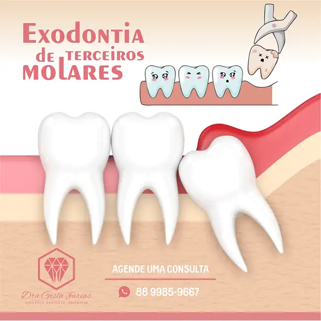 Propaganda Exodontia de Terceiro Molares

