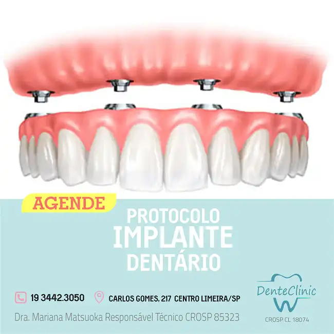 Propaganda Protocolo Implante Dentário
