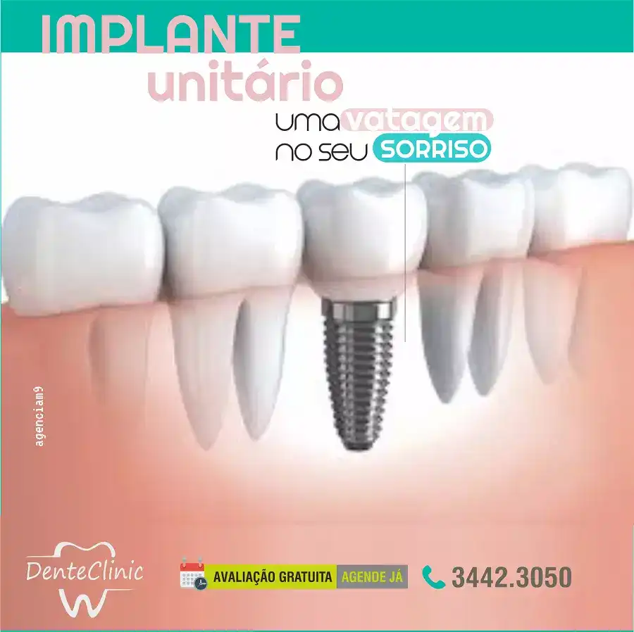 Propaganda Sobre Implante Unitário criada para Clínica Odontológica
