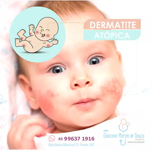 Propaganda sobre Dermatite Atópica para Clínica Pediátrica

