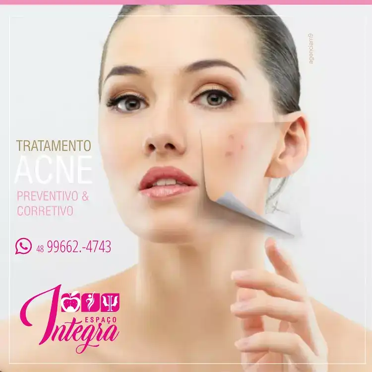 Propaganda sobre Tratamento de Acne criado para Clínica Estética de Florianópolis Santa Catarina
